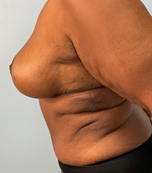 Liposuction After Photo by Julia Spears, MD, FACS; Marlton, NJ - Case 51267
