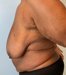 Liposuction Before Photo by Julia Spears, MD, FACS; Marlton, NJ - Case 51267