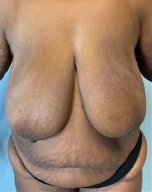 Liposuction Before Photo by Julia Spears, MD, FACS; Marlton, NJ - Case 51267