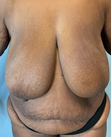 Tummy Tuck Before Photo by Julia Spears, MD, FACS; Marlton, NJ - Case 51265