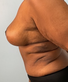 Tummy Tuck After Photo by Julia Spears, MD, FACS; Marlton, NJ - Case 51265