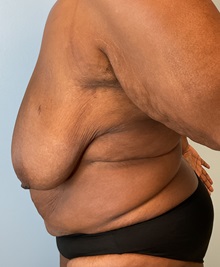 Tummy Tuck Before Photo by Julia Spears, MD, FACS; Marlton, NJ - Case 51265