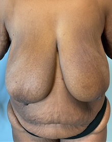 Breast Reduction Before Photo by Julia Spears, MD, FACS; Marlton, NJ - Case 51266
