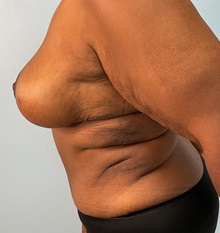 Breast Reduction After Photo by Julia Spears, MD, FACS; Marlton, NJ - Case 51266