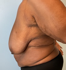 Breast Reduction Before Photo by Julia Spears, MD, FACS; Marlton, NJ - Case 51266