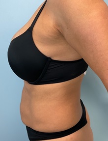 Liposuction Before Photo by Julia Spears, MD, FACS; Marlton, NJ - Case 51269
