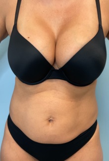 Tummy Tuck Before Photo by Julia Spears, MD, FACS; Marlton, NJ - Case 51268