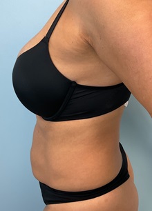 Tummy Tuck Before Photo by Julia Spears, MD, FACS; Marlton, NJ - Case 51268