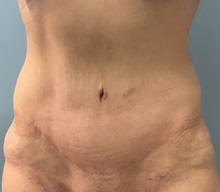 Tummy Tuck After Photo by Julia Spears, MD, FACS; Marlton, NJ - Case 51340