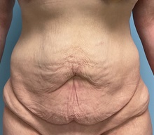Tummy Tuck Before Photo by Julia Spears, MD, FACS; Marlton, NJ - Case 51340