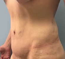 Tummy Tuck After Photo by Julia Spears, MD, FACS; Marlton, NJ - Case 51340