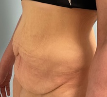 Tummy Tuck Before Photo by Julia Spears, MD, FACS; Marlton, NJ - Case 51340