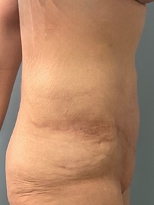Tummy Tuck After Photo by Julia Spears, MD, FACS; Marlton, NJ - Case 51340