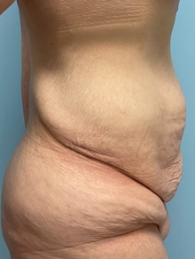 Tummy Tuck Before Photo by Julia Spears, MD, FACS; Marlton, NJ - Case 51340
