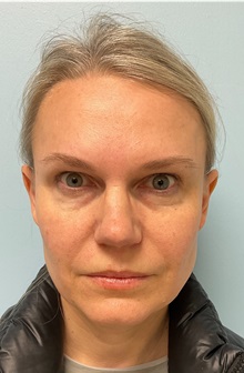 Botulinum Toxin After Photo by Julia Spears, MD, FACS; Marlton, NJ - Case 51352
