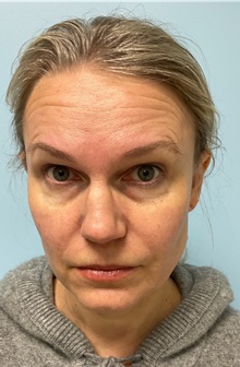 Botulinum Toxin Before Photo by Julia Spears, MD, FACS; Marlton, NJ - Case 51352