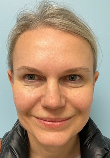 Botulinum Toxin After Photo by Julia Spears, MD, FACS; Marlton, NJ - Case 51352