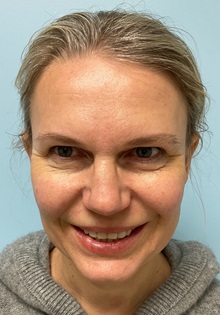 Botulinum Toxin Before Photo by Julia Spears, MD, FACS; Marlton, NJ - Case 51352