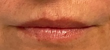 Lip Augmentation/Enhancement After Photo by Julia Spears, MD, FACS; Marlton, NJ - Case 51362