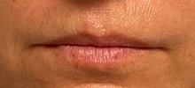 Lip Augmentation/Enhancement Before Photo by Julia Spears, MD, FACS; Marlton, NJ - Case 51362