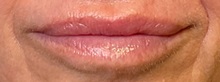Lip Augmentation/Enhancement After Photo by Julia Spears, MD, FACS; Marlton, NJ - Case 51363
