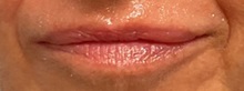 Lip Augmentation/Enhancement Before Photo by Julia Spears, MD, FACS; Marlton, NJ - Case 51363