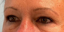 Eyelid Surgery After Photo by Julia Spears, MD, FACS; Marlton, NJ - Case 51526