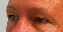 Eyelid Surgery Before Photo by Julia Spears, MD, FACS; Marlton, NJ - Case 51526