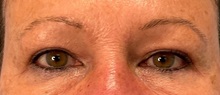 Eyelid Surgery After Photo by Julia Spears, MD, FACS; Marlton, NJ - Case 51526