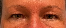 Eyelid Surgery Before Photo by Julia Spears, MD, FACS; Marlton, NJ - Case 51526