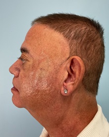 Dermal Fillers After Photo by Julia Spears, MD, FACS; Marlton, NJ - Case 51530