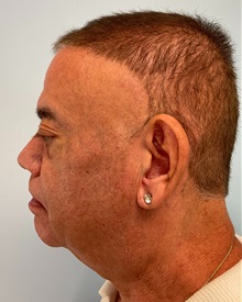 Dermal Fillers Before Photo by Julia Spears, MD, FACS; Marlton, NJ - Case 51530