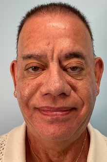 Dermal Fillers After Photo by Julia Spears, MD, FACS; Marlton, NJ - Case 51530