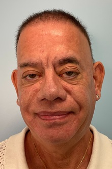 Dermal Fillers Before Photo by Julia Spears, MD, FACS; Marlton, NJ - Case 51530