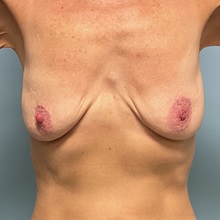 Breast Augmentation Before Photo by Julia Spears, MD, FACS; Marlton, NJ - Case 51527