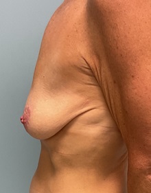 Breast Augmentation Before Photo by Julia Spears, MD, FACS; Marlton, NJ - Case 51527