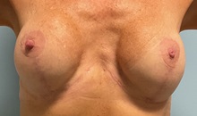 Chemical Peels, IPL, Fractional CO2 Laser Treatments After Photo by Julia Spears, MD, FACS; Marlton, NJ - Case 51539