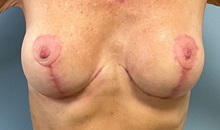 Chemical Peels, IPL, Fractional CO2 Laser Treatments Before Photo by Julia Spears, MD, FACS; Marlton, NJ - Case 51539