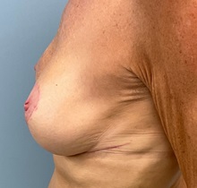 Chemical Peels, IPL, Fractional CO2 Laser Treatments Before Photo by Julia Spears, MD, FACS; Marlton, NJ - Case 51539