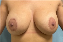 Breast Augmentation After Photo by Julia Spears, MD, FACS; Marlton, NJ - Case 49307