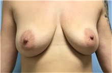 Breast Augmentation Before Photo by Julia Spears, MD, FACS; Marlton, NJ - Case 49307