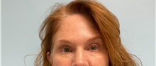 Botulinum Toxin After Photo by Julia Spears, MD, FACS; Marlton, NJ - Case 49308