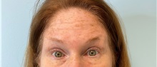 Botulinum Toxin Before Photo by Julia Spears, MD, FACS; Marlton, NJ - Case 49308