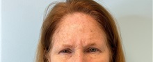 Botulinum Toxin Before Photo by Julia Spears, MD, FACS; Marlton, NJ - Case 49308