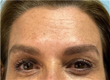 Botulinum Toxin After Photo by Julia Spears, MD, FACS; Marlton, NJ - Case 49818 Botulinum Toxin After Photo by Julia Spears, MD, FACS; Marlton, NJ - Case 49818