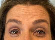 Botulinum Toxin Before Photo by Julia Spears, MD, FACS; Marlton, NJ - Case 49818 Botulinum Toxin Before Photo by Julia Spears, MD, FACS; Marlton, NJ - Case 49818