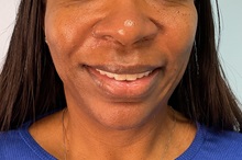 Dermal Fillers After Photo by Julia Spears, MD, FACS; Marlton, NJ - Case 49827 Dermal Fillers After Photo by Julia Spears, MD, FACS; Marlton, NJ - Case 49827