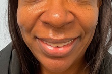 Dermal Fillers Before Photo by Julia Spears, MD, FACS; Marlton, NJ - Case 49827 Dermal Fillers Before Photo by Julia Spears, MD, FACS; Marlton, NJ - Case 49827