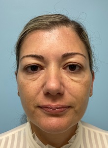 Botulinum Toxin Before Photo by Julia Spears, MD, FACS; Marlton, NJ - Case 49842 Botulinum Toxin Before Photo by Julia Spears, MD, FACS; Marlton, NJ - Case 49842