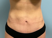 Tummy Tuck After Photo by Julia Spears, MD, FACS; Marlton, NJ - Case 49844 Tummy Tuck After Photo by Julia Spears, MD, FACS; Marlton, NJ - Case 49844